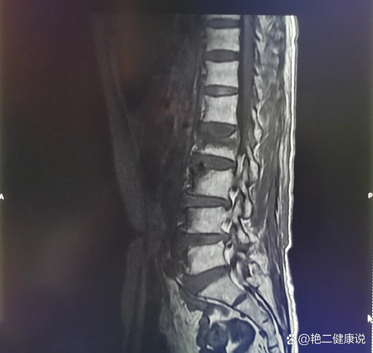 腰椎多个腰椎间盘突出伴压缩骨折磁共振图像