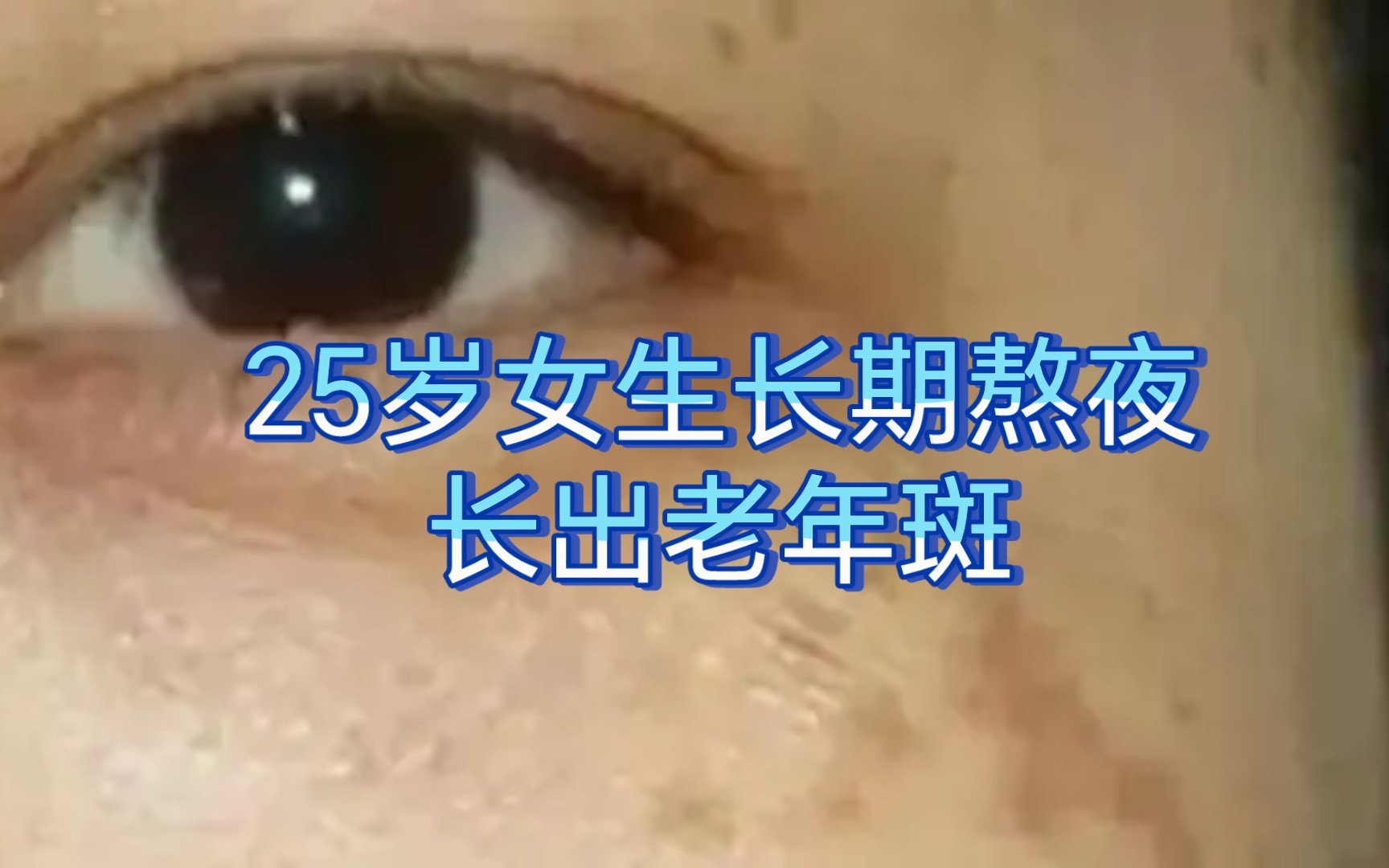 25岁的女生因为长期熬夜,竟然长出了老年斑