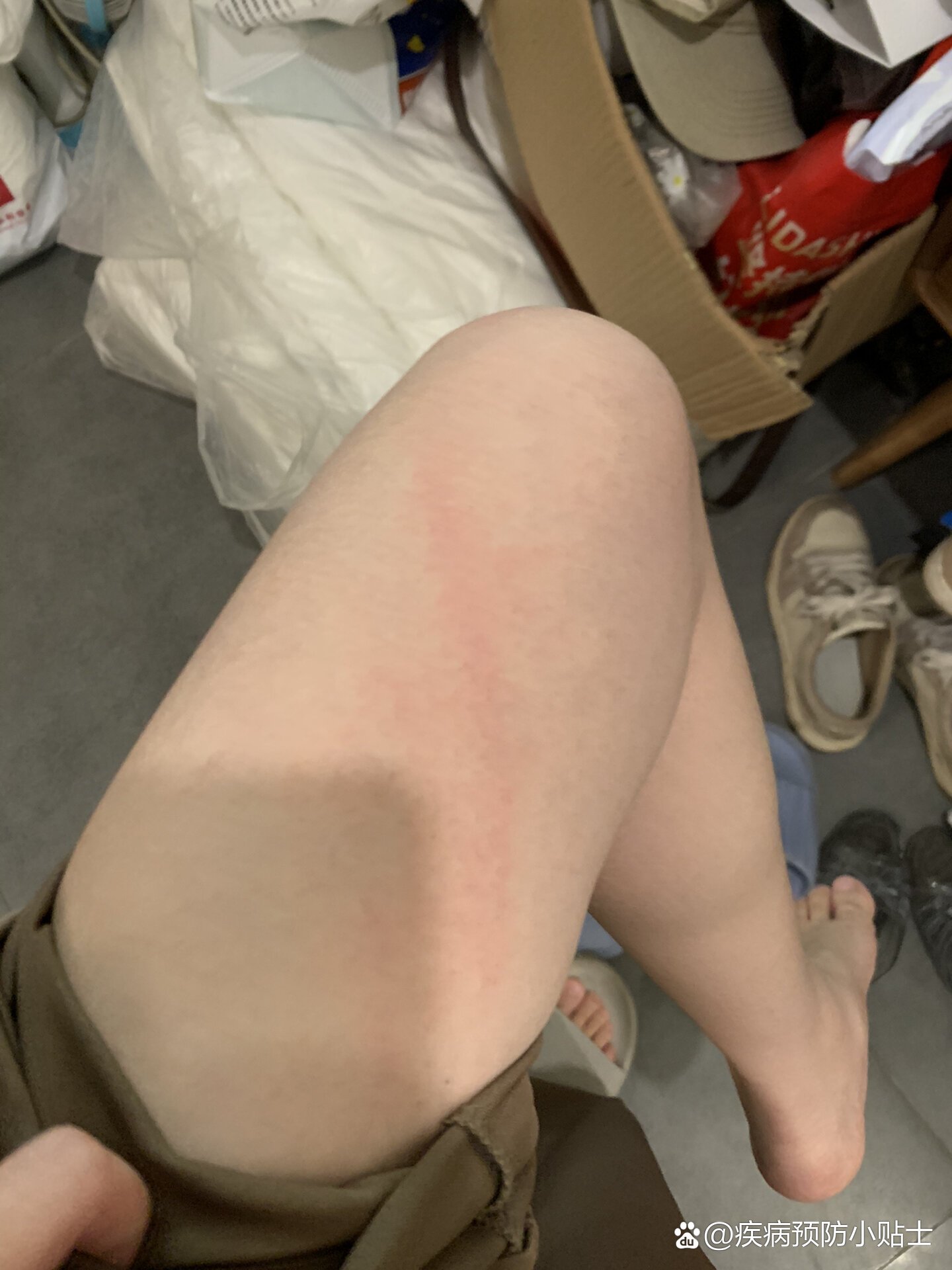 被狗狗抓出红痕,没破皮没出血,半个月过去了,心里还是有点害怕,现在打