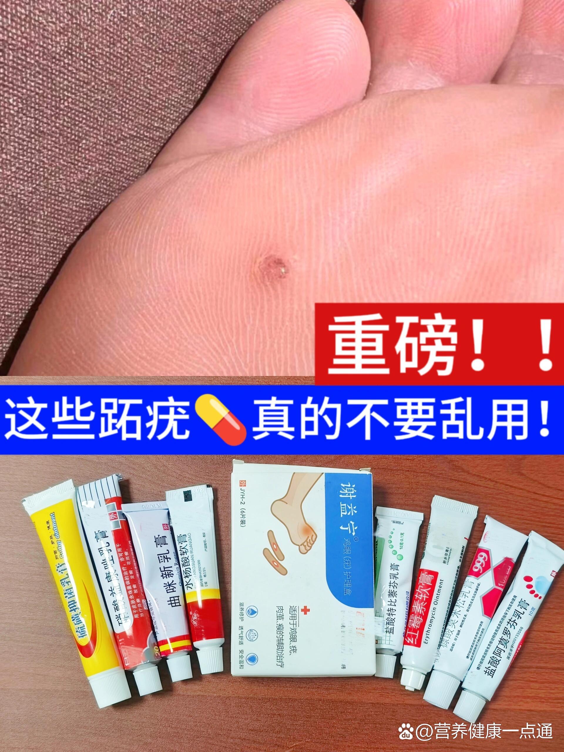 有跖疣的进来抄作业!