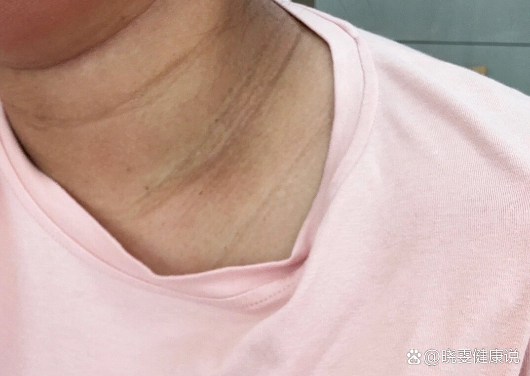 孕晚期脖子黑