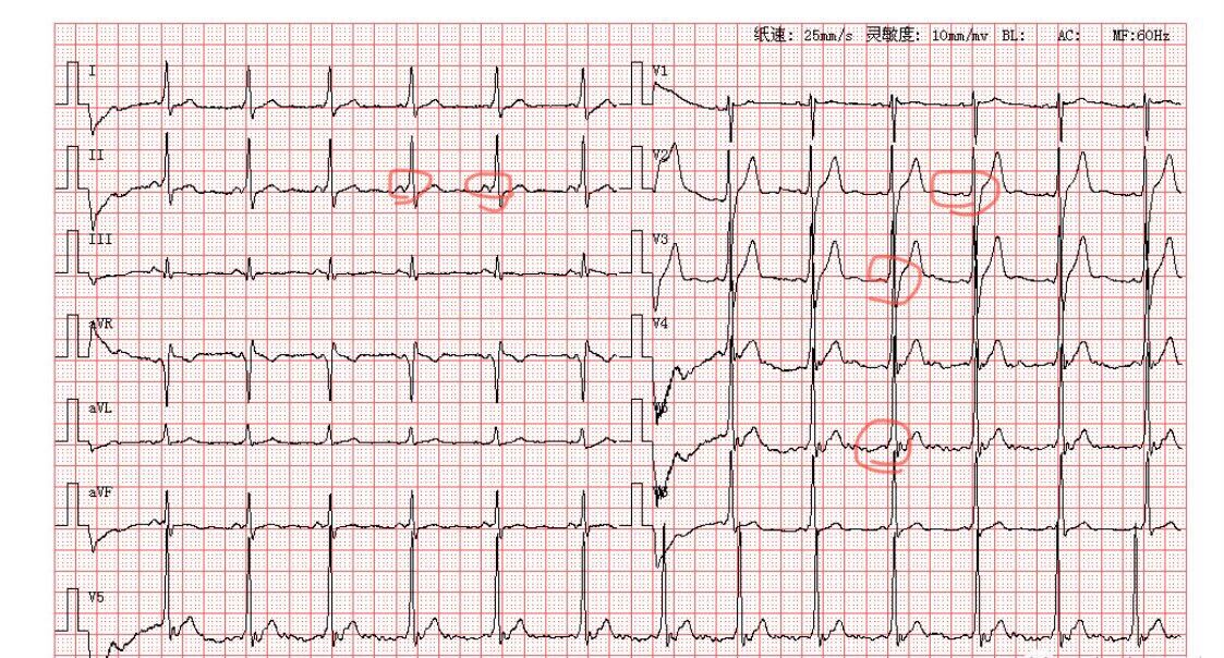 B型预激综合征心电图图片