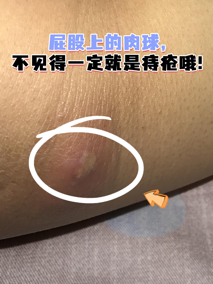 👦有一天,堂哥神秘兮兮地找到我,说他的屁股上长了个小肉球,一碰