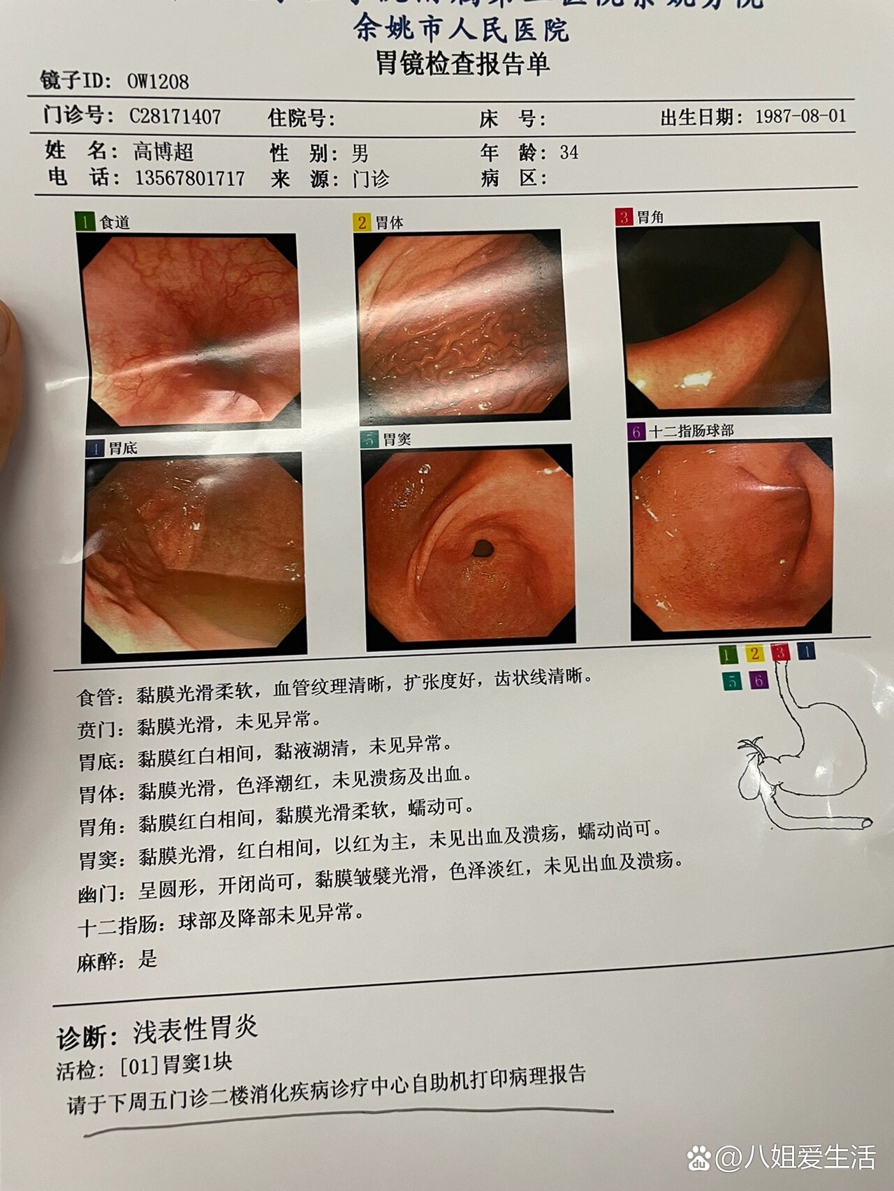 胃镜正常结果图片