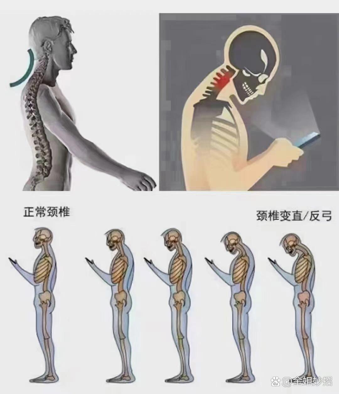 人体正常的颈椎呈"c"形