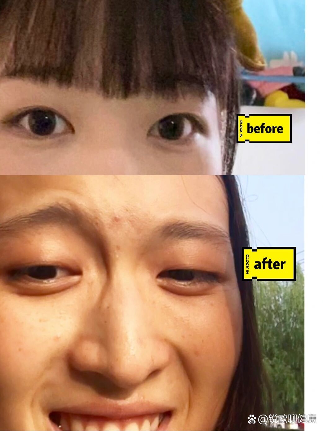 毁容了,戴眼镜戴的|近视眼变形经验分享(一)