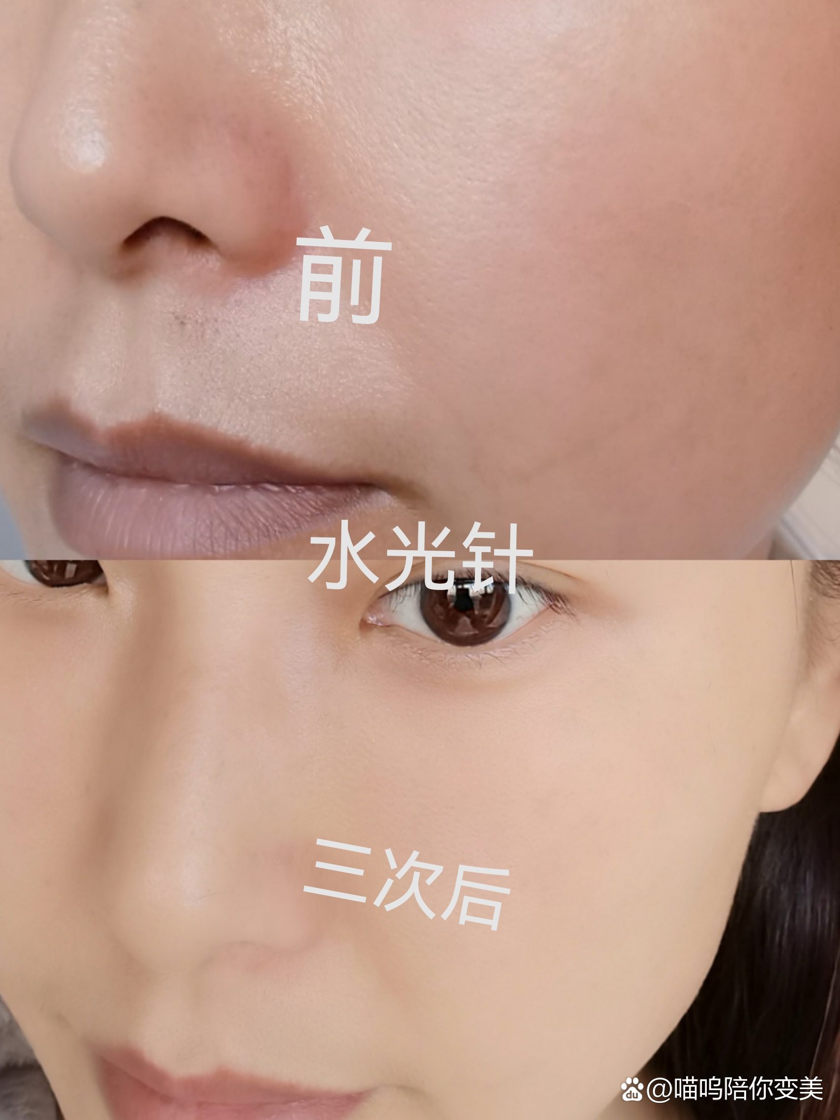  br>⭐作用 br>水光针的主要作用是将玻尿酸注射进皮肤后为皮肤补水