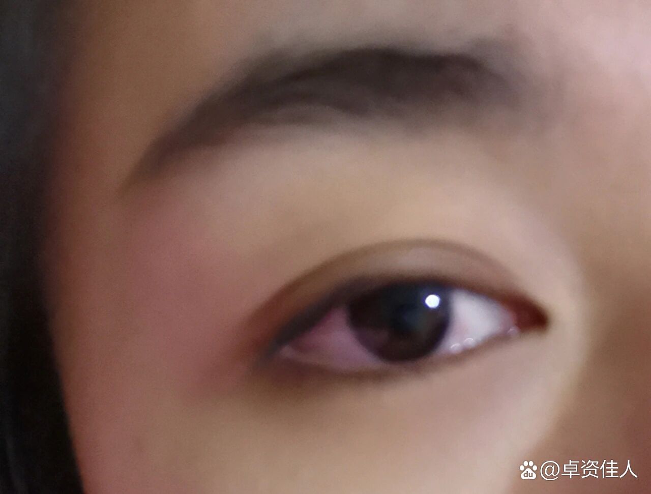 戴美瞳眼睛发红戴美瞳眼部不适的照片眼球发炎有凸起美瞳眼睛疼怎么办