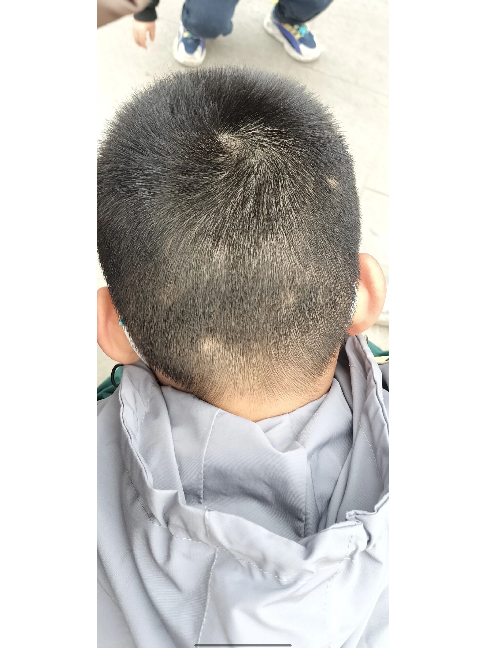 10周岁的男孩头发突然出现少头发