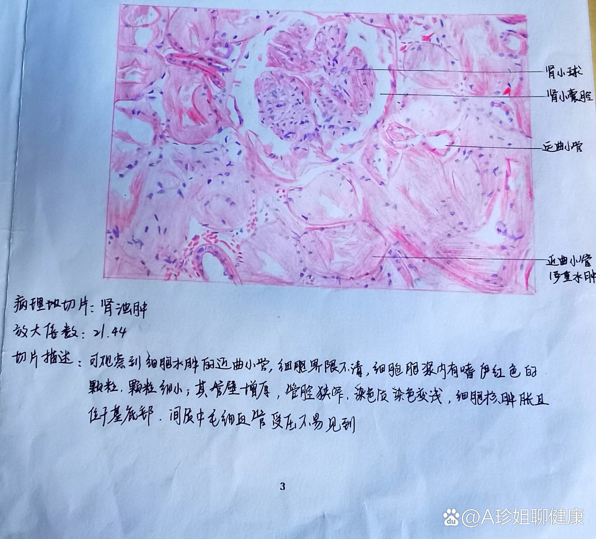 肾浊肿手绘实验报告图图片