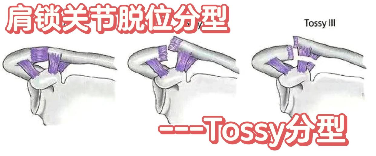 肩锁关节脱位Tossy分型详解