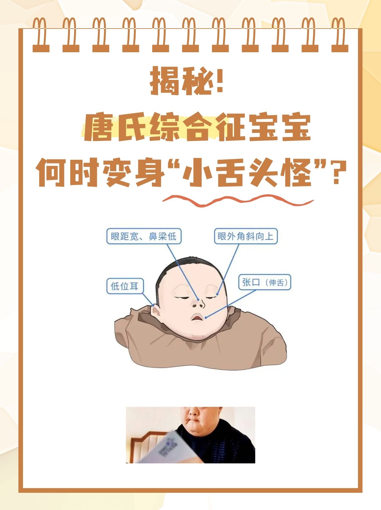 揭秘 唐氏综合征宝宝何时变身小舌头怪?