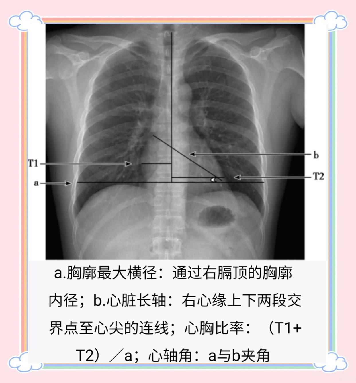 X线胸片心血管测量指南