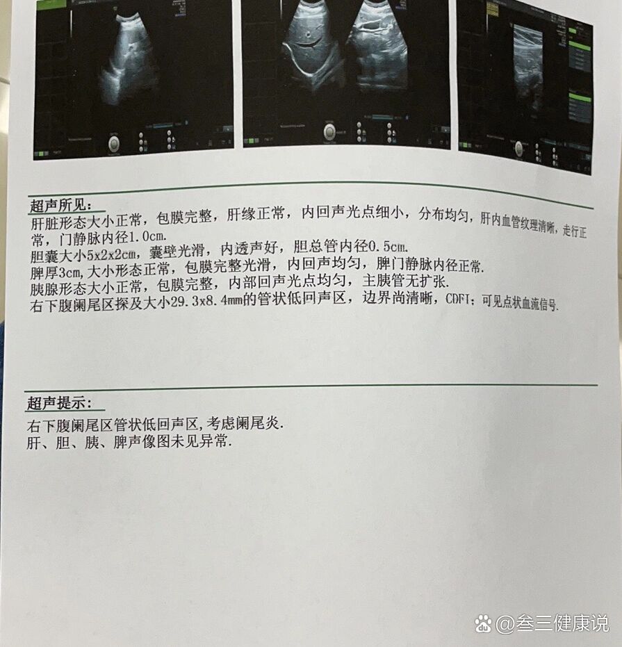 急性阑尾炎报告图片