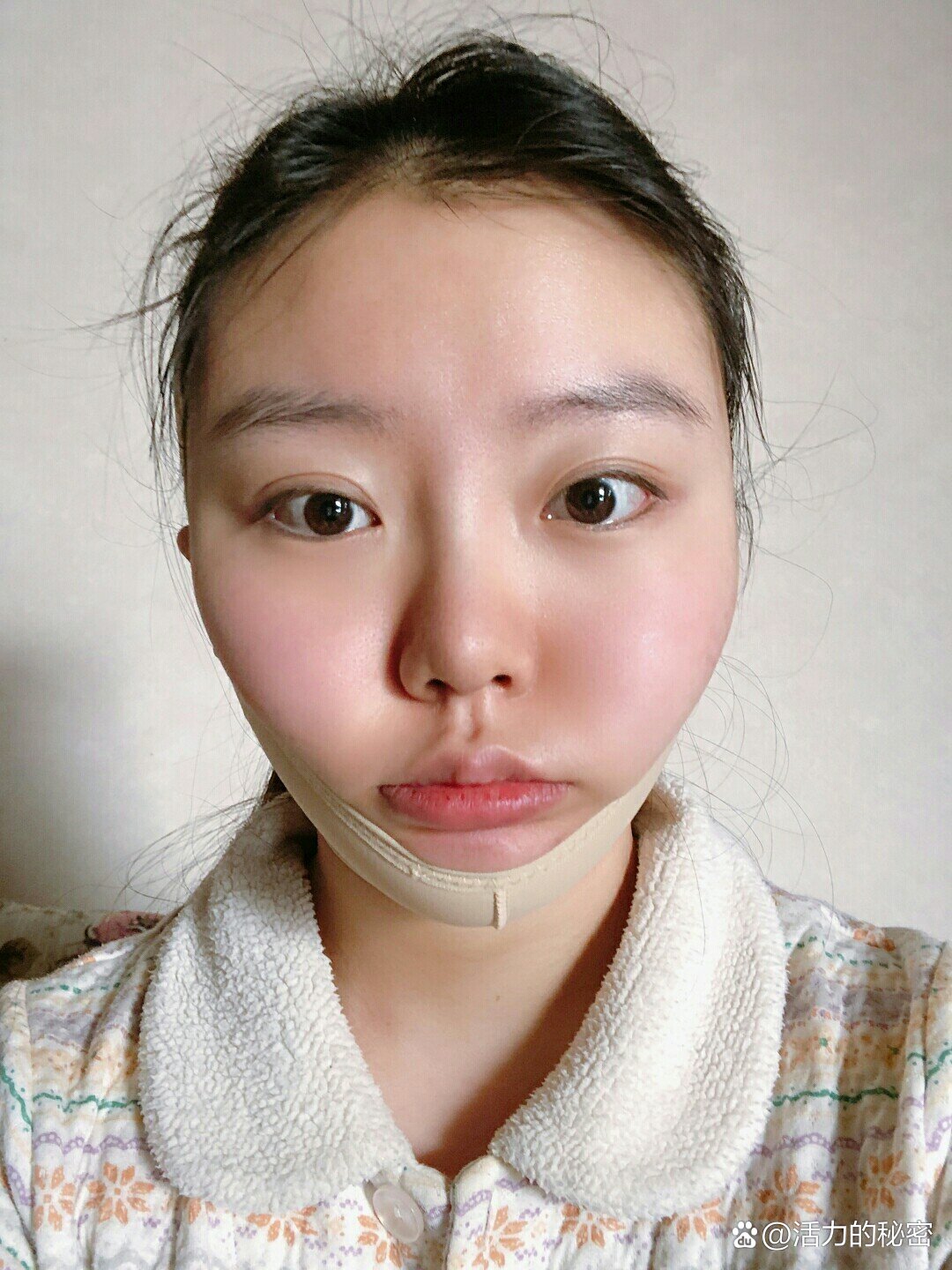 下颌缘吸脂后第③天