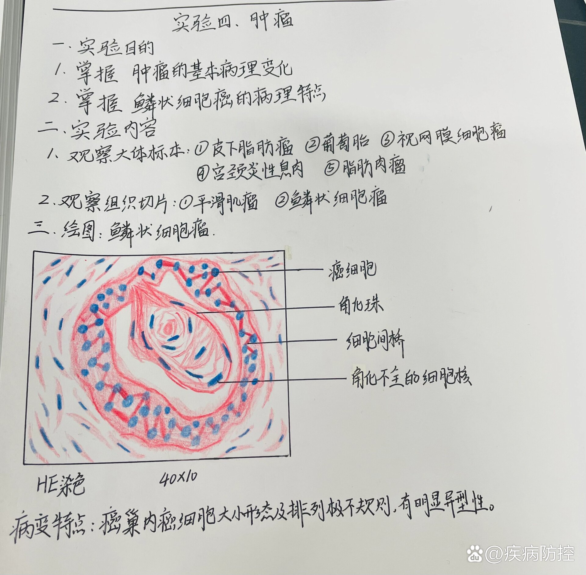 病理实验阑尾炎手绘图图片