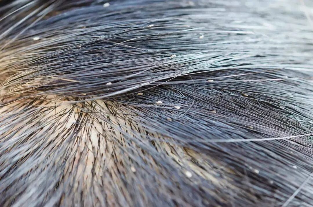 得头虱需要注意个人卫生