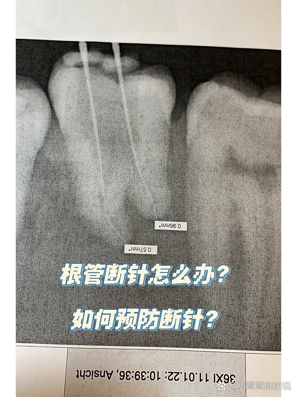 根管治疗时断针怎么办?