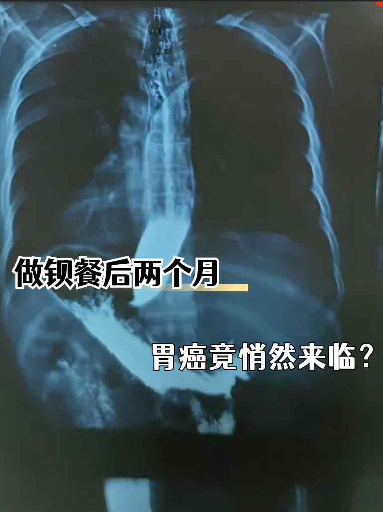做钡餐后两个月:胃癌竟悄然来袭?
