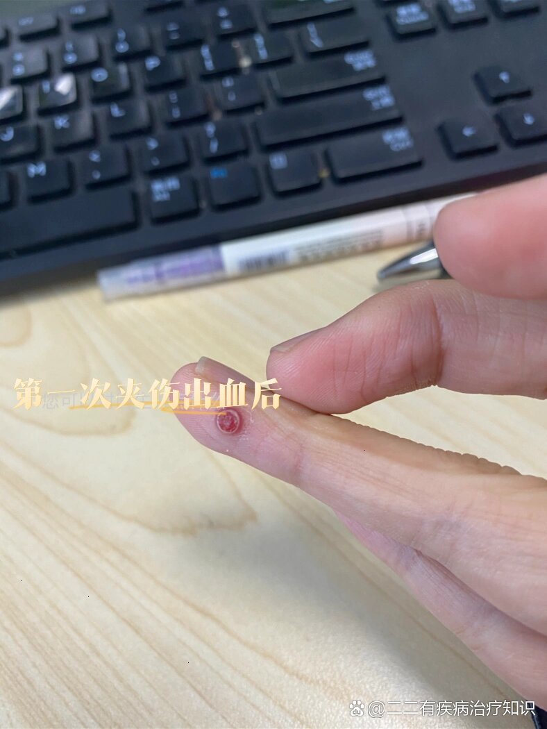 哺乳期手指化脓性肉芽肿记