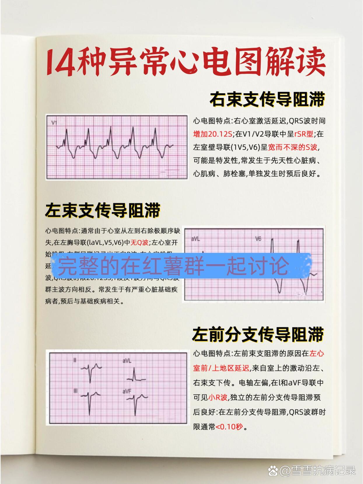 十三种异常心电图图片