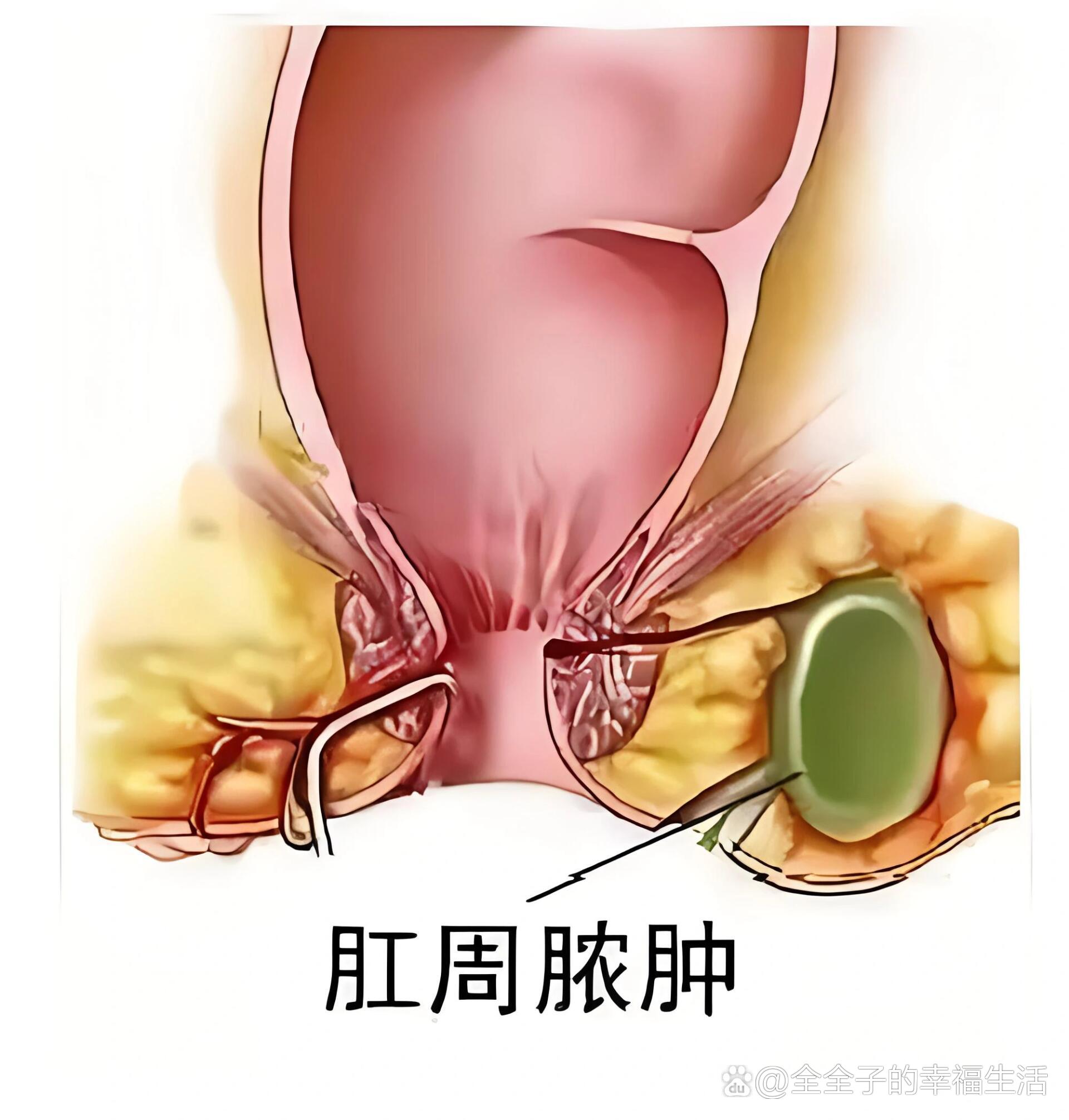 肛门直肠周围脓肿的简称,是由于细菌感染所致的软组织急性化脓性疾病