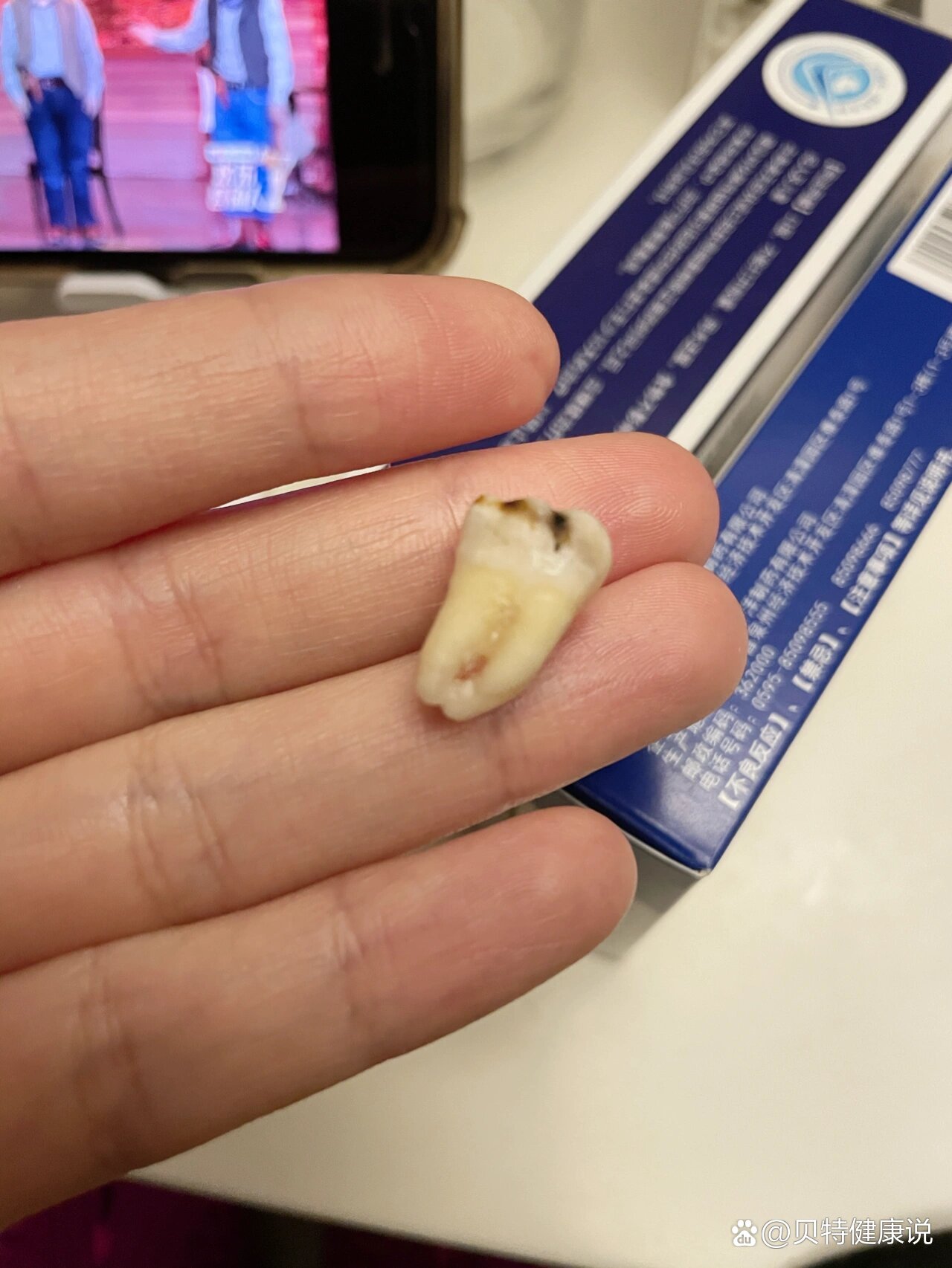 拔牙第三天得了干槽症,医生不打麻药刮治