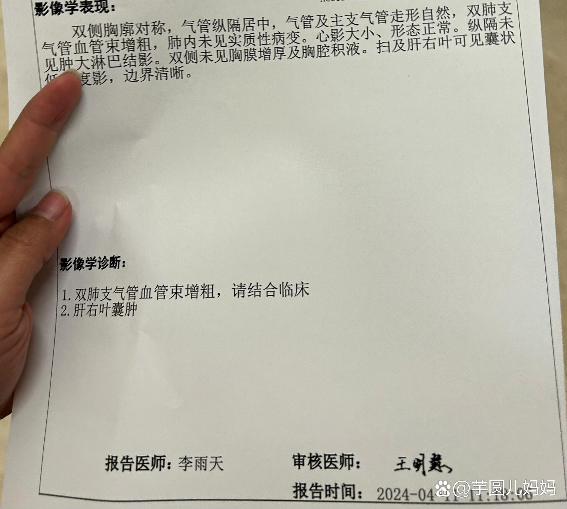 肝囊肿会自愈吗