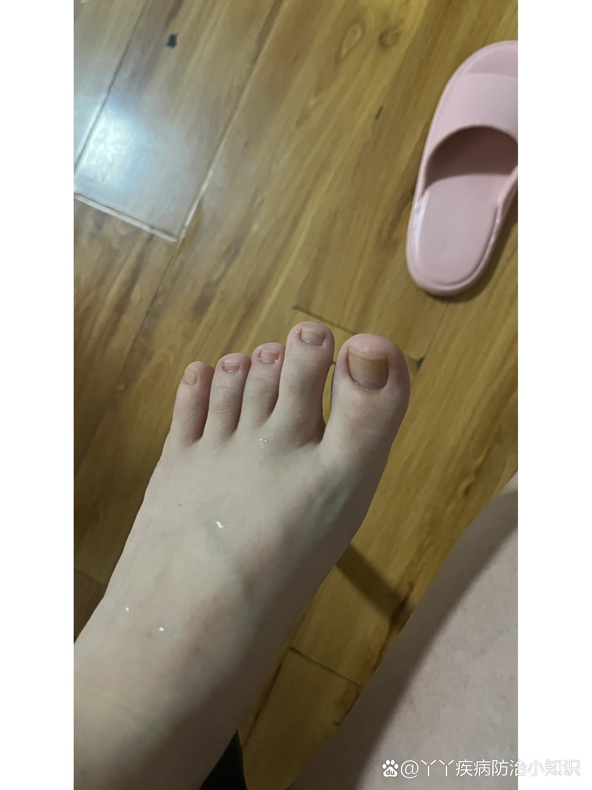 脚趾甲翘起来还有救吗?