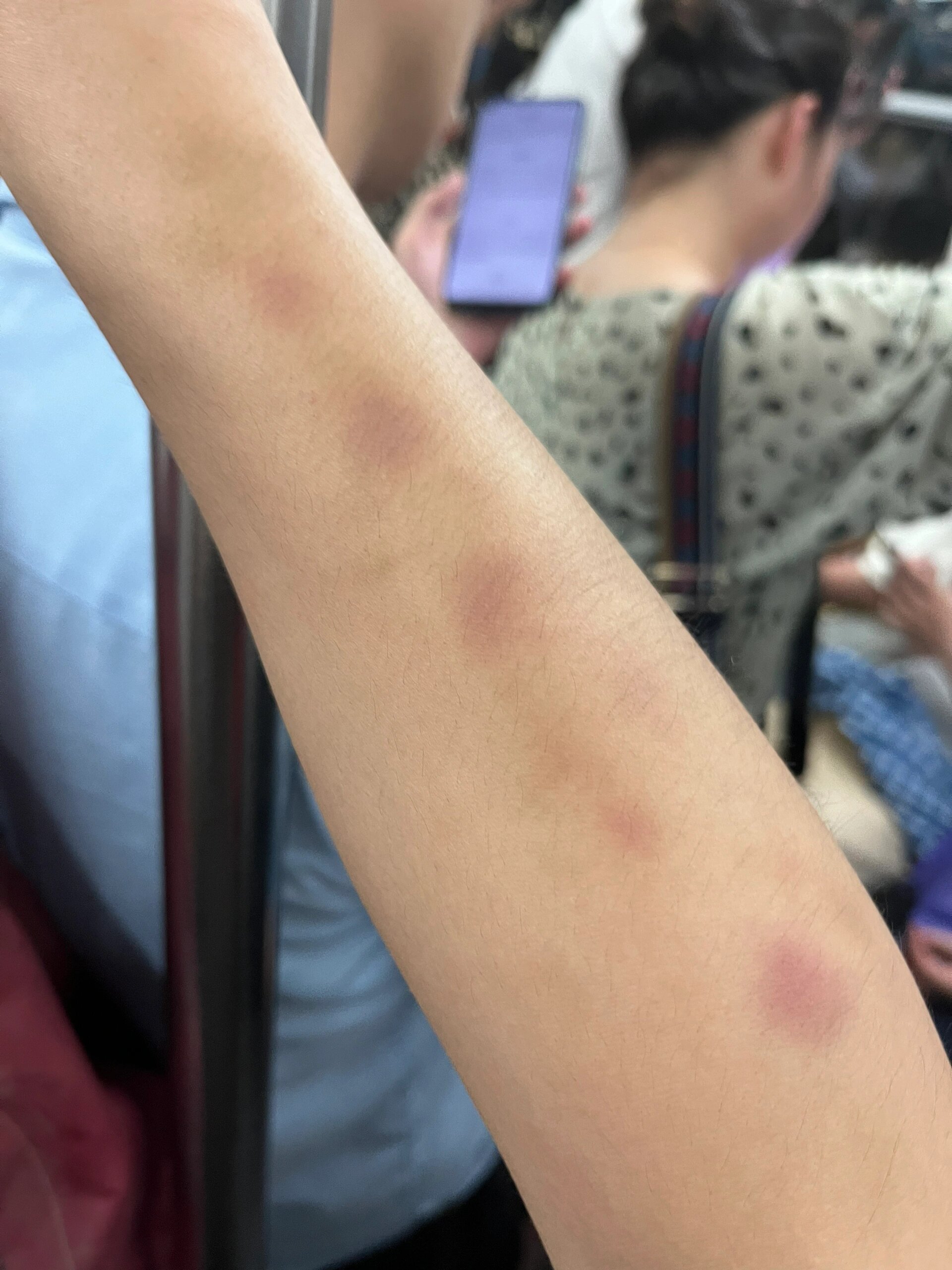 家人们,问下这是什么原因啊,胳膊上莫名其妙出现淤青像是被人掐了