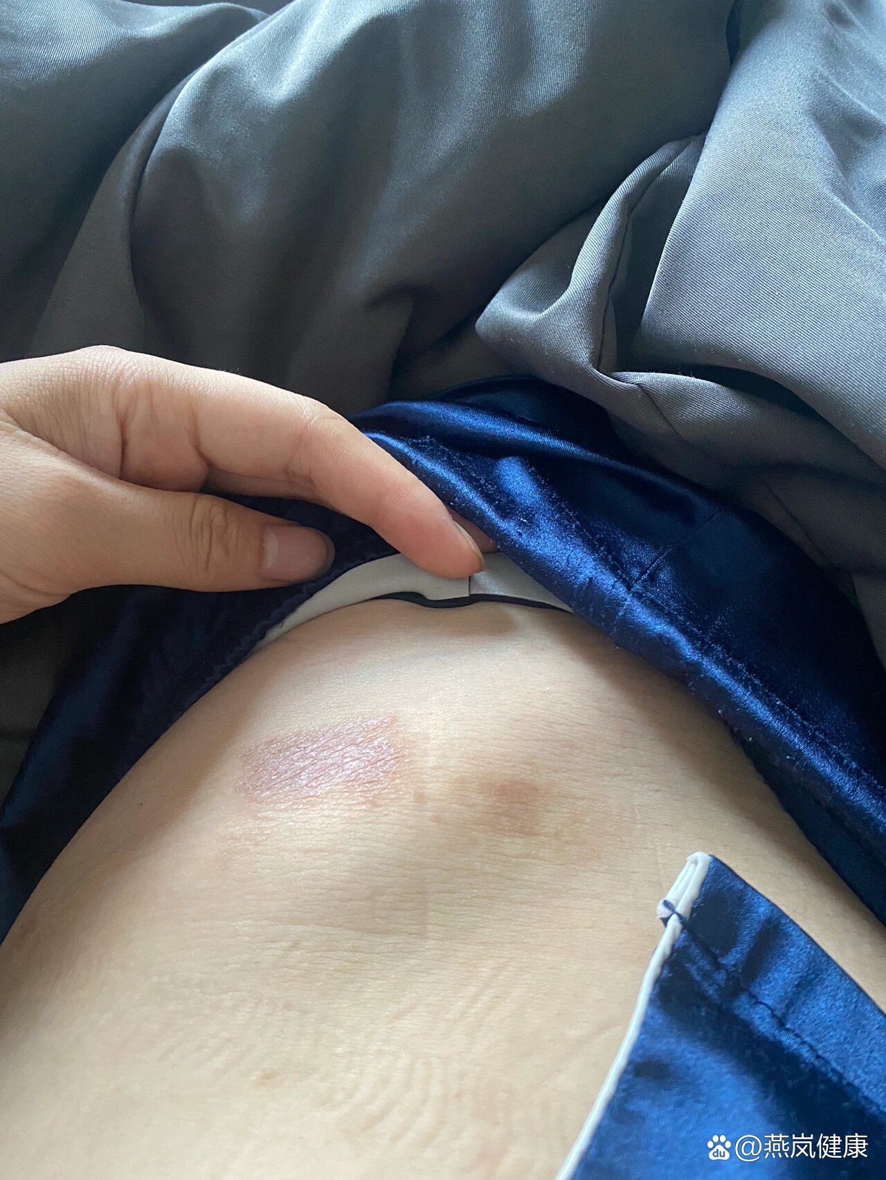 特异性皮炎终于好了