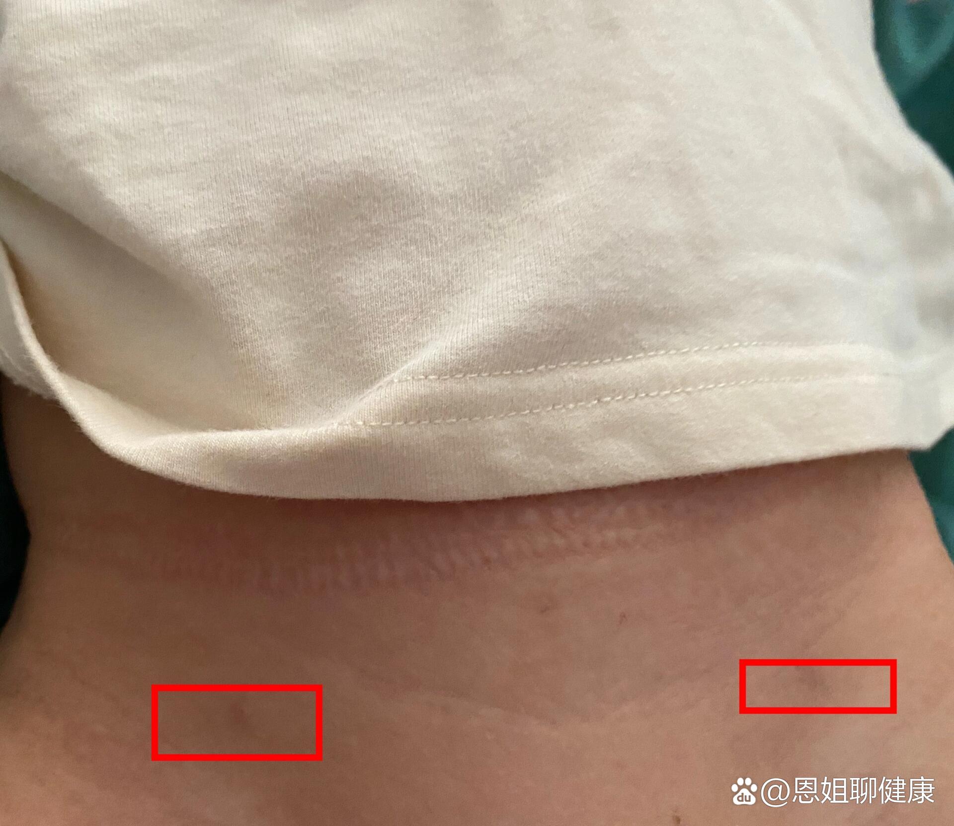 右侧大腿根儿处会鼓出一个鸡蛋大小的包,去医院检查确诊是腹股沟斜疝