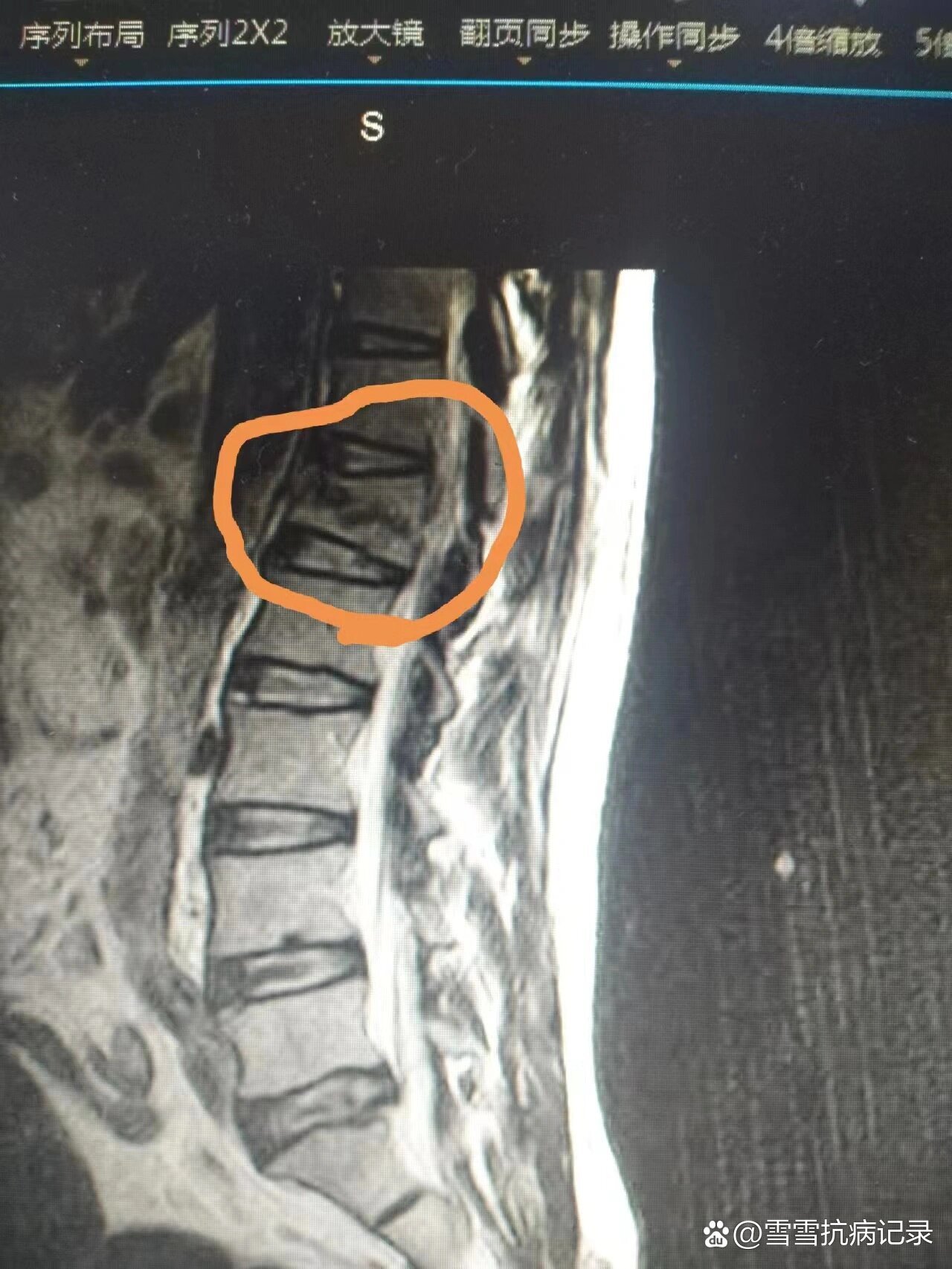 腰椎l1压缩性骨折