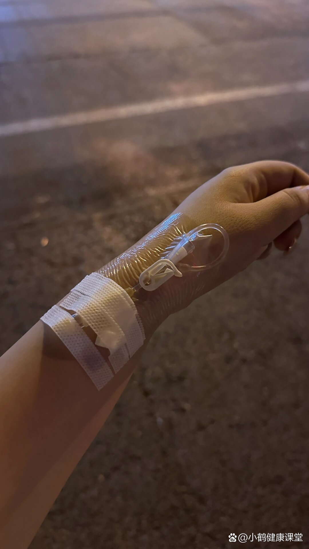 急性扁桃体化脓发炎记录(下篇)