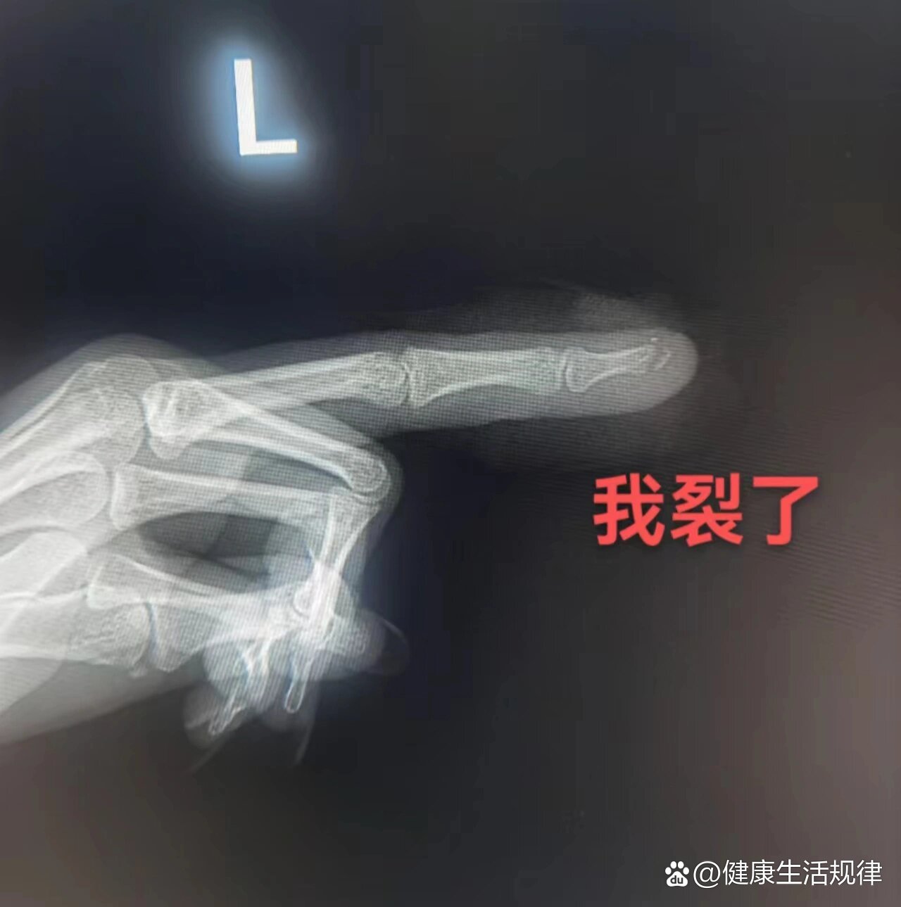 指尖骨折的家人们多久恢复的?