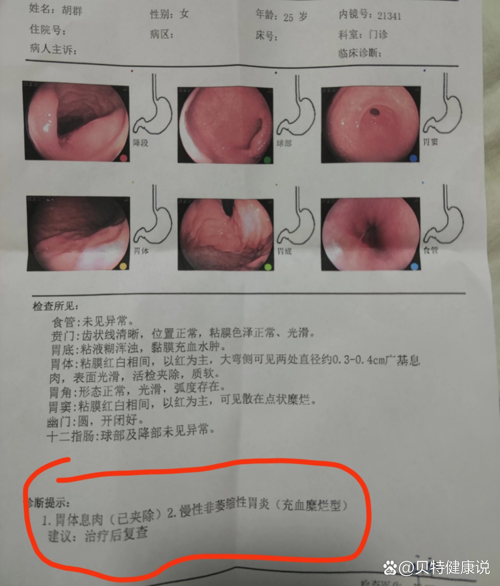 千万不要做普通胃镜
