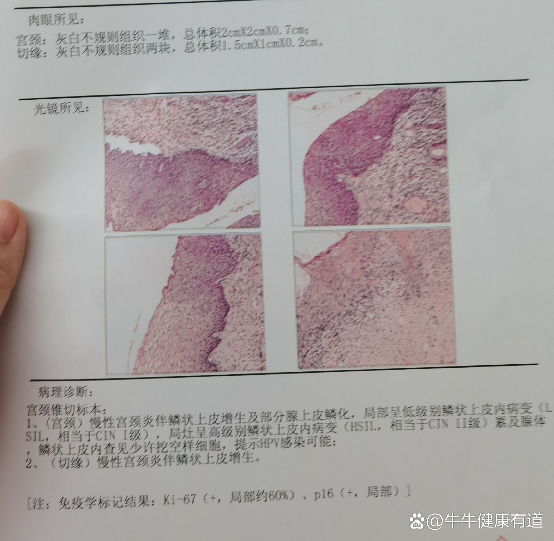 一,hpv16,宫颈活检leep刀,cin2累及腺体