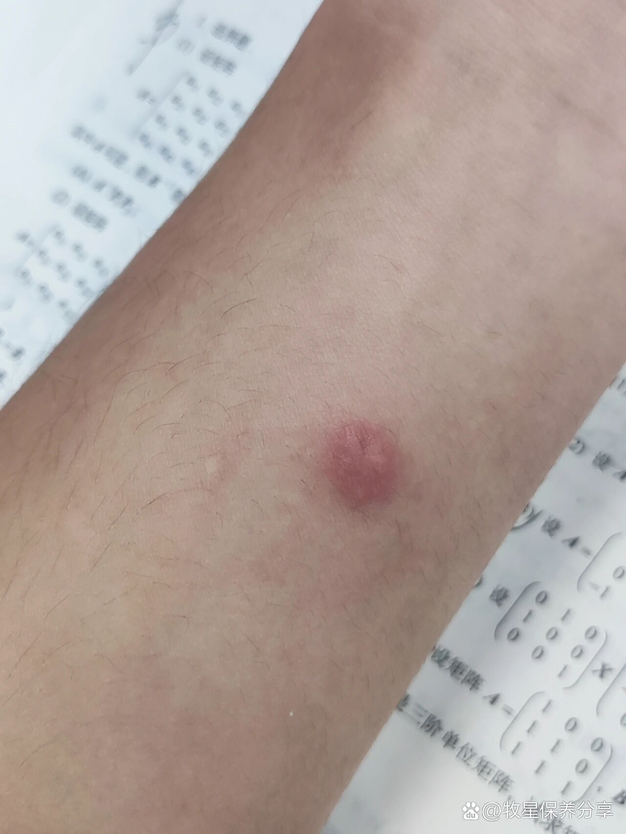 皮试四天了,医生之前说的弱阳性,但现在变红了