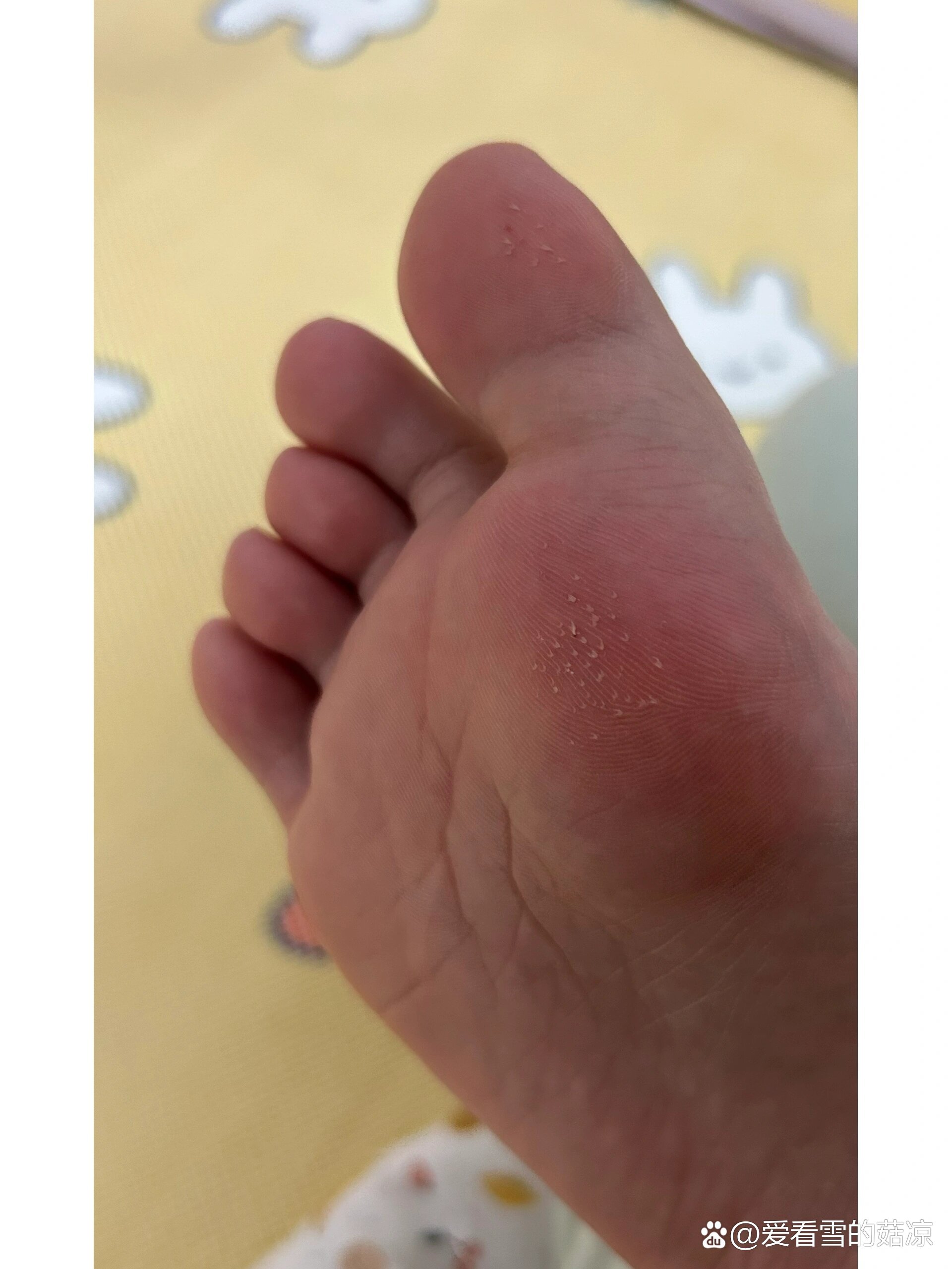 脚底板也长倒刺?