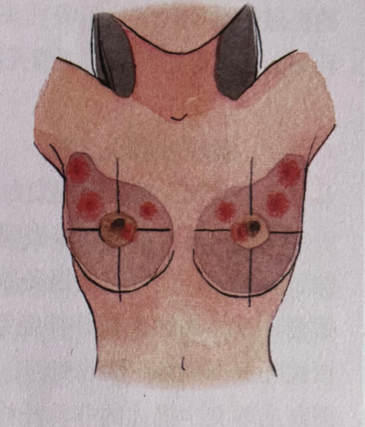 乳房摸到肿块,一定是乳腺癌吗?