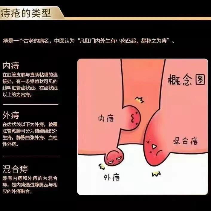 肛门外长痔疮图片图片