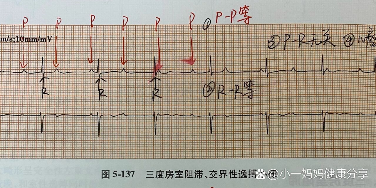 心房心室图简易图片