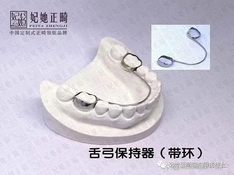  br>1)间隙保持器的种类 br>(1)固定式间隙保持器:舌弓式间隙保持器