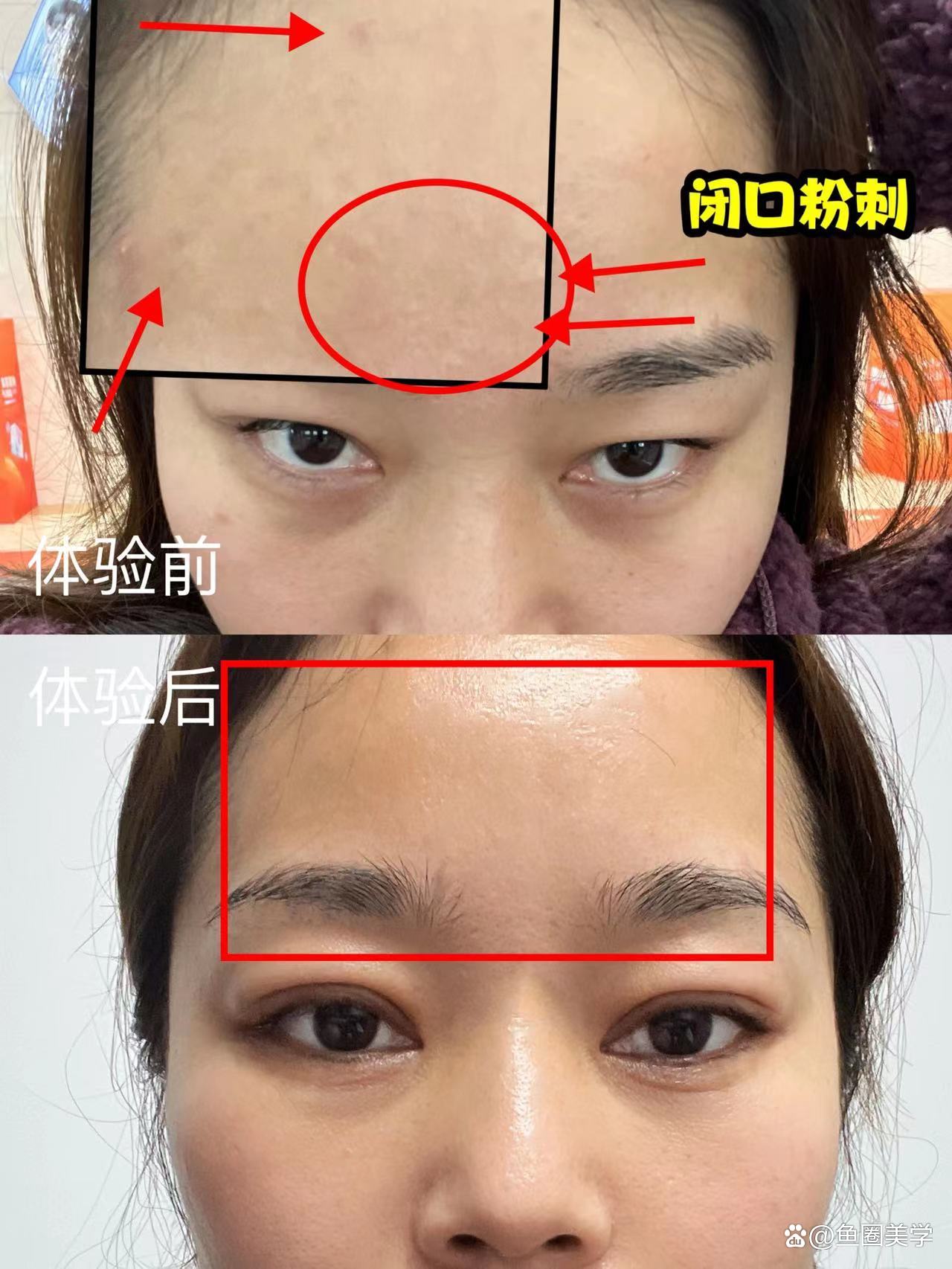 导致皮肤越来越差伴随着面部水油失衡很多人面部会出现痘痘闭口粉刺