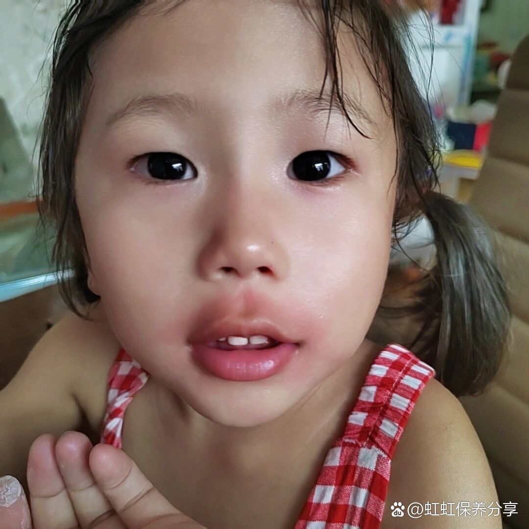 吃桃子过敏,这招真的管用!