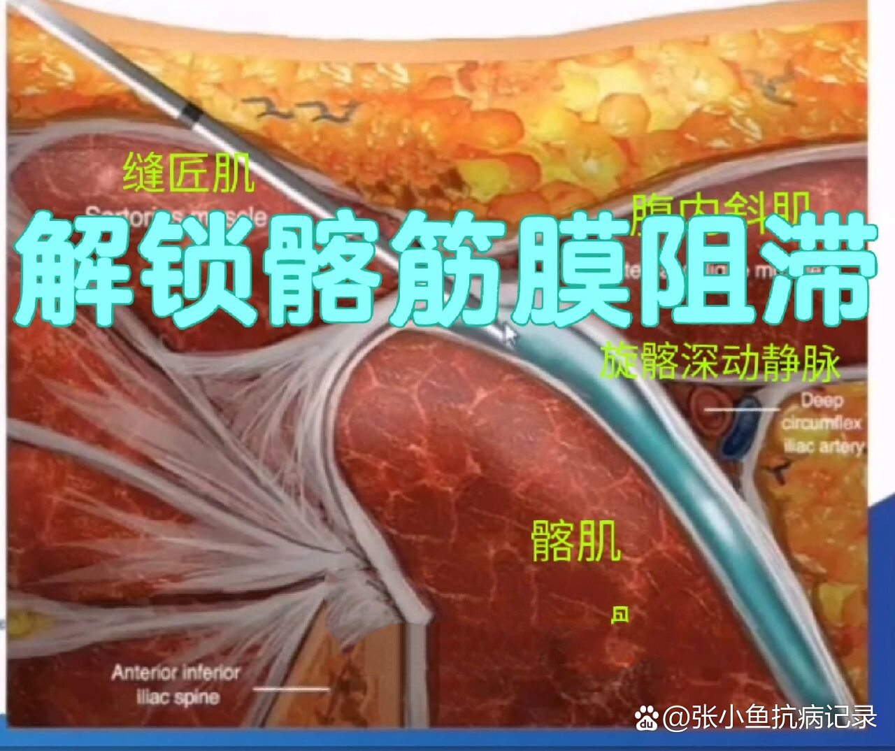 髂筋膜间隙阻滞图片