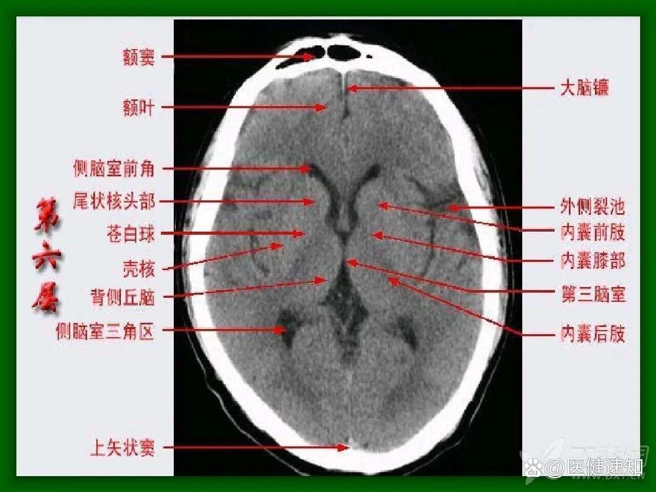 认识脑部断层结构第一层:突出认识筛窦,蝶窦,脑桥,第四脑室