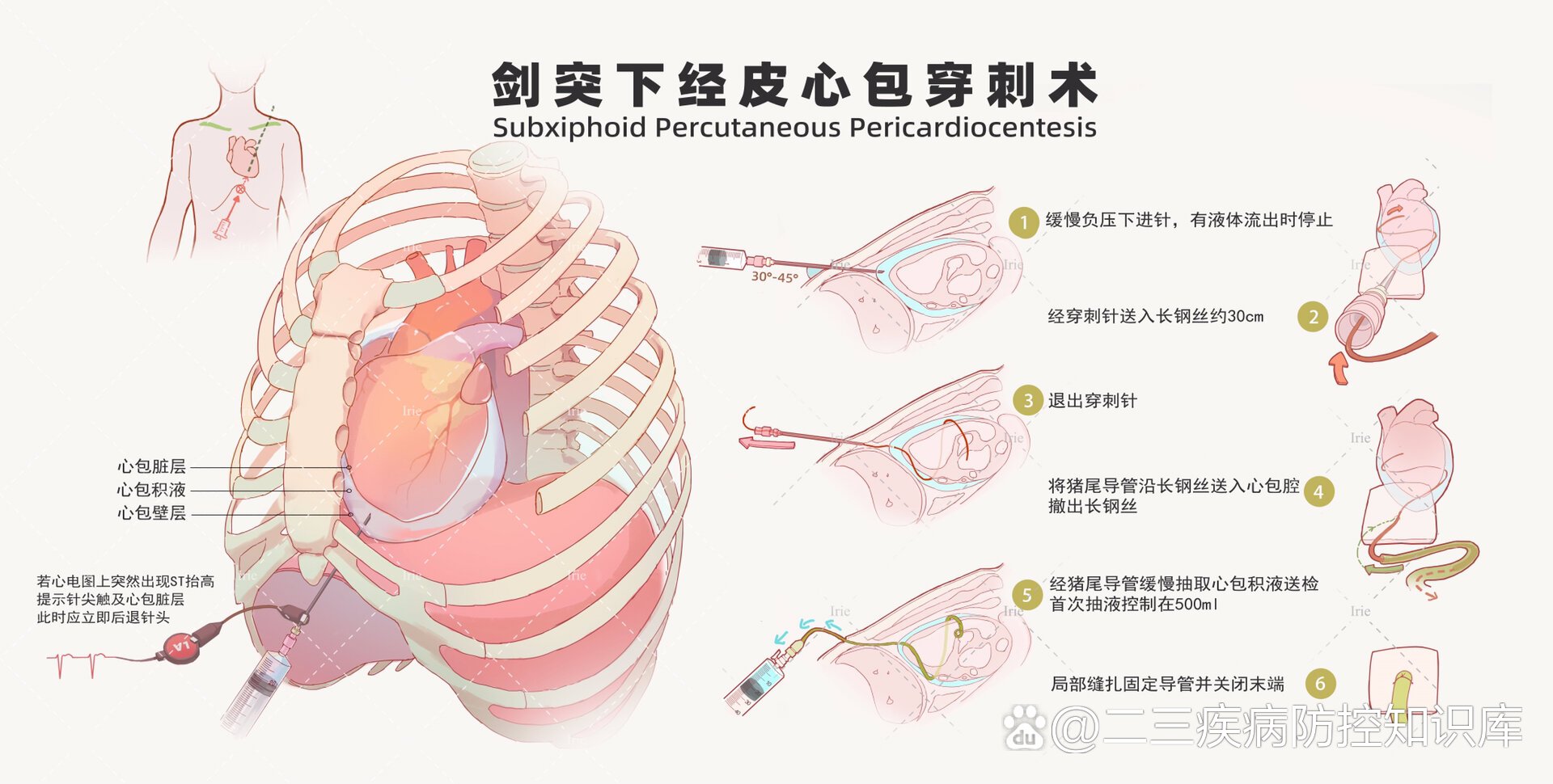 医学插画