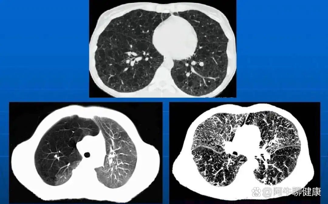 慢阻肺,在肺ct上能看出来吗?