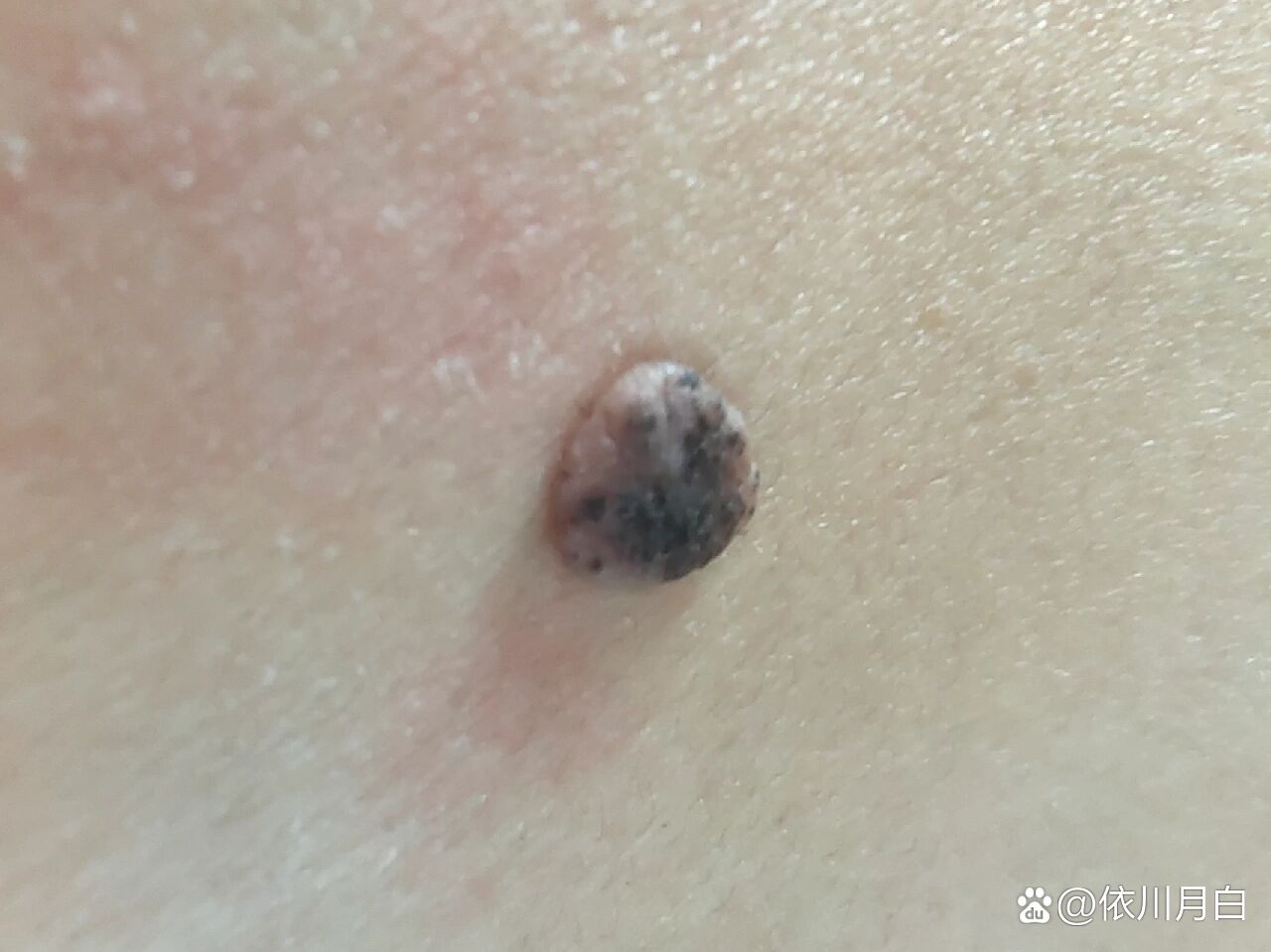 背上有个大肉痣